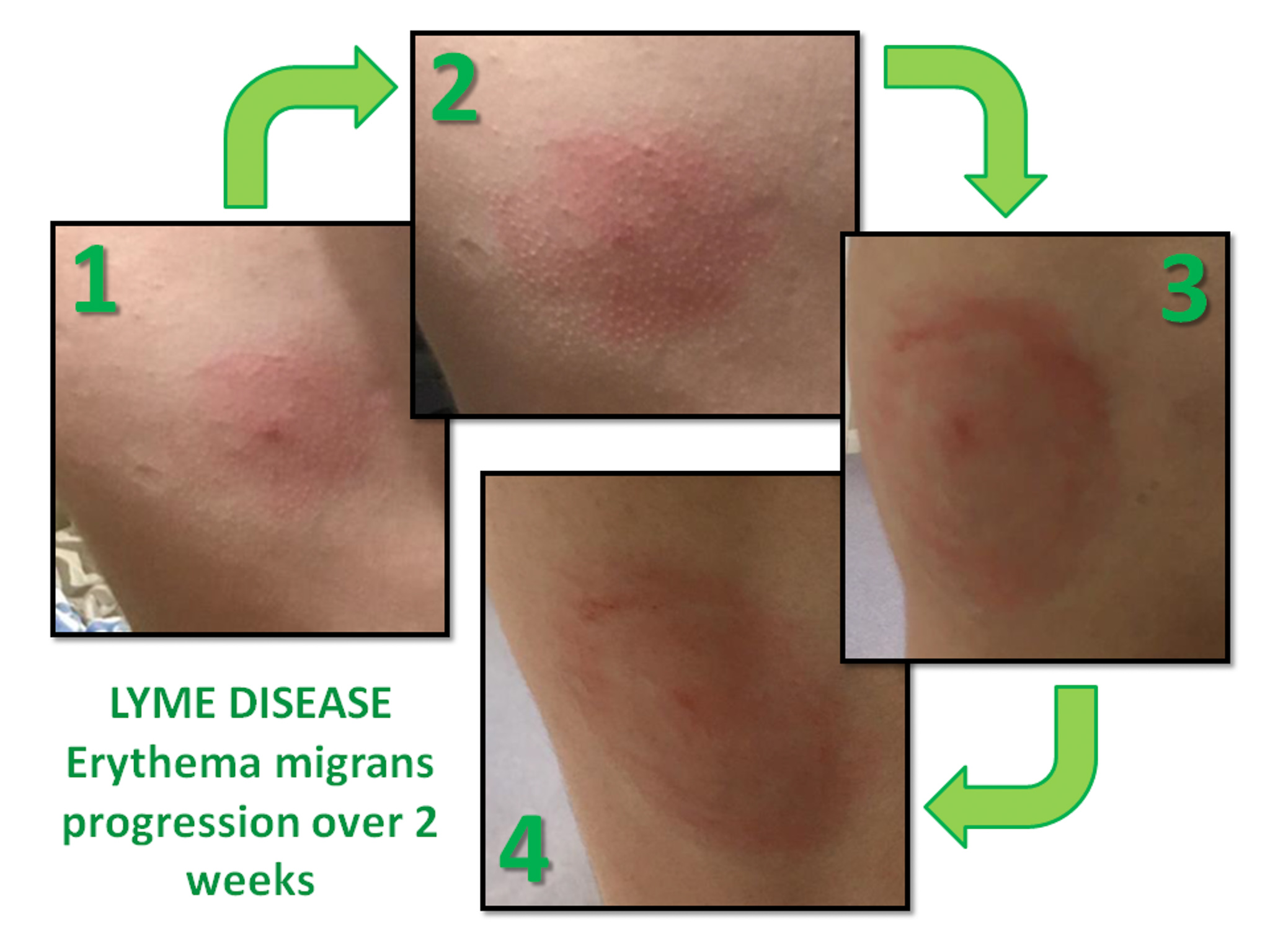 Different Stages Of Lyme Disease